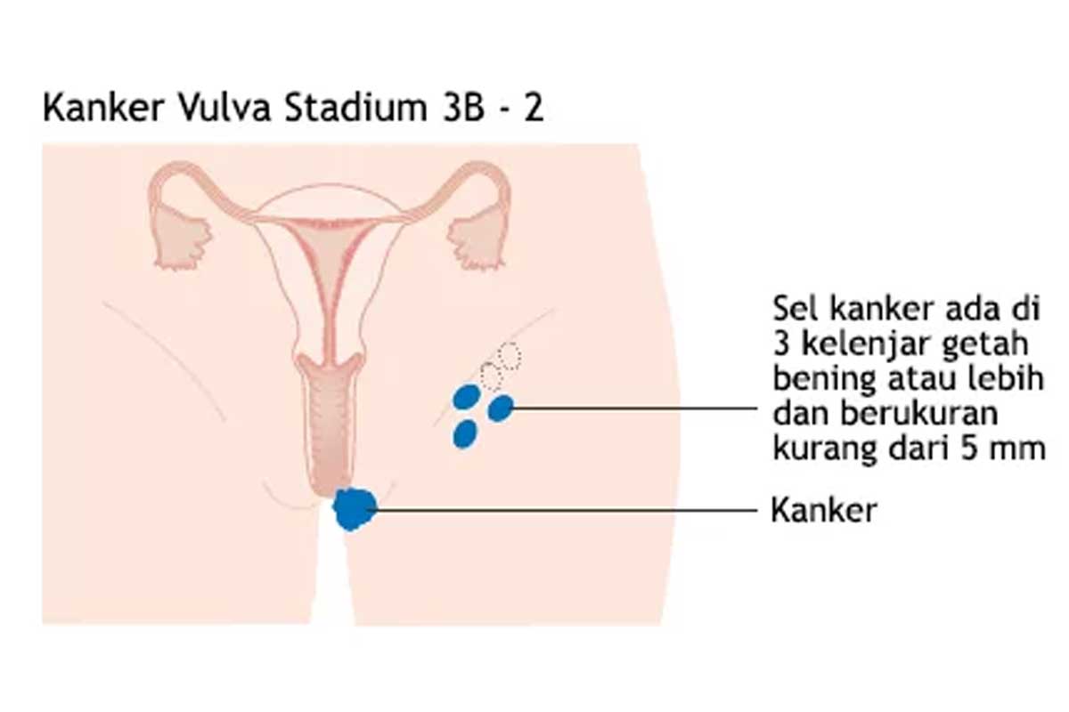 Waspada Ini Gejala Awal Kanker Vulva