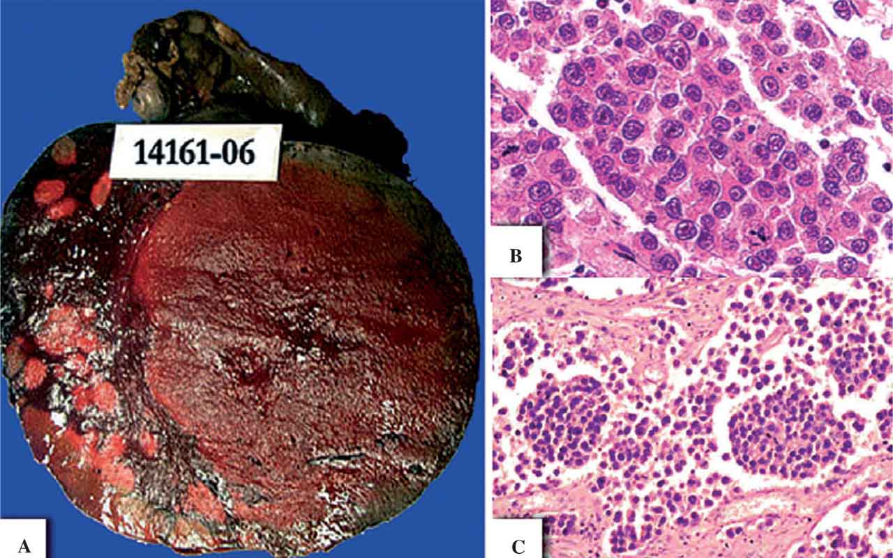 Disgerminoma: Tumor Germinal Ovarium yang Perlu Diwaspadai
