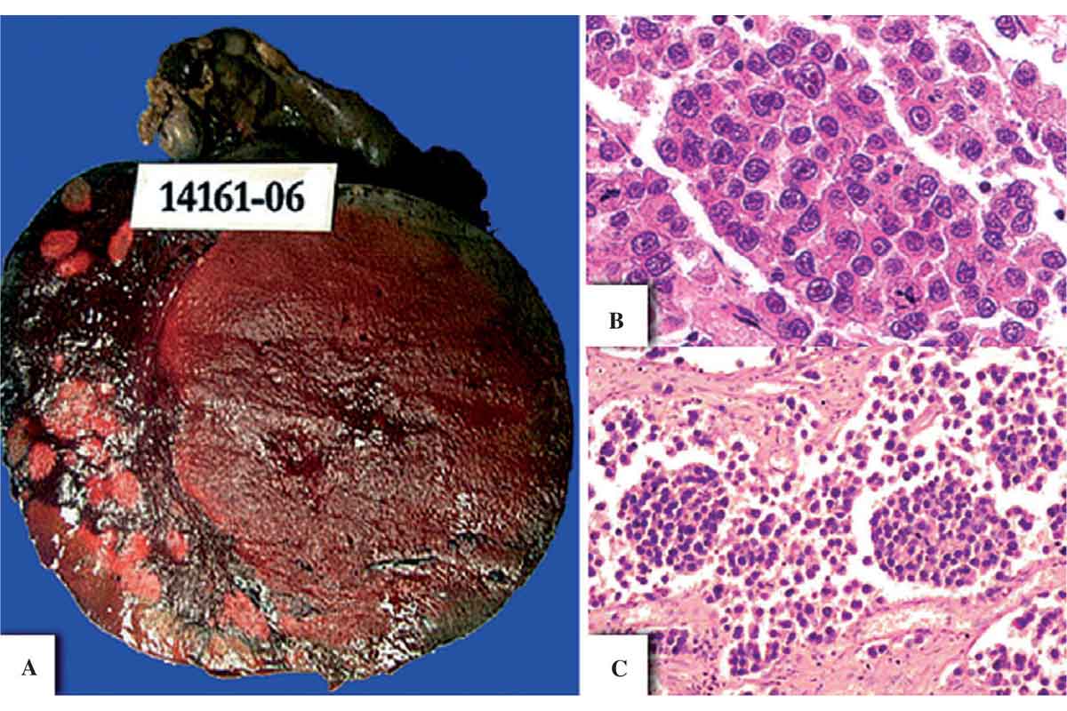 Mengenal Disgerminoma: Tumor Ganas pada Indung Telur yang Perlu Diwaspadai