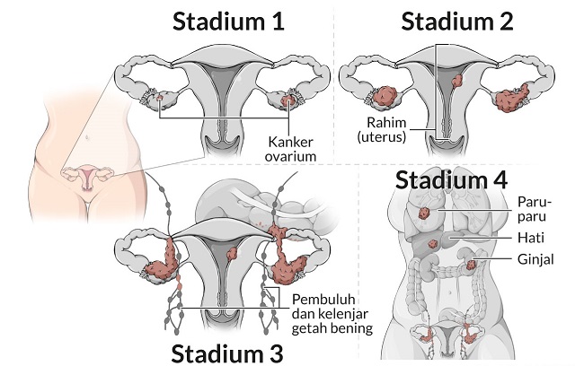 Kanker Tuba Falopi: Mengenal, Mencegah, dan Menjaga Kesehatan Reproduksi Wanita