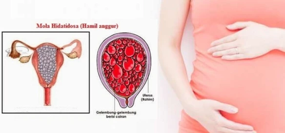 Ciri-ciri Terkena Penyakit Trofoblas Ganas