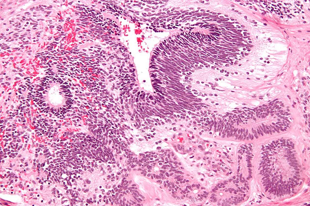 Imature Teratoma: Memahami Tumor Ganas yang Langka