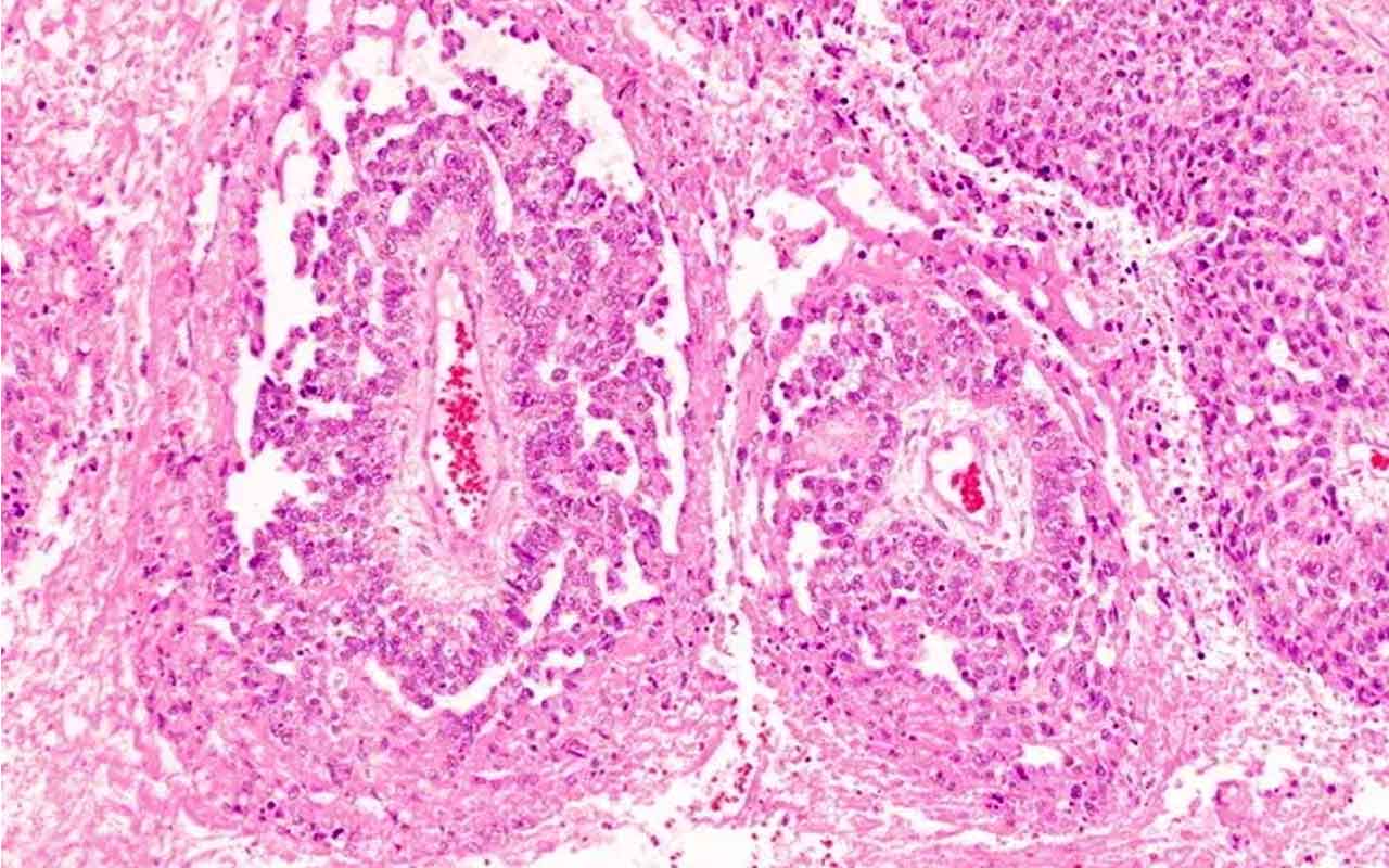 Yolk Sac Tumor (Tumor Kantung Kuning Telur): Memahami Jenis dan Karakteristiknya