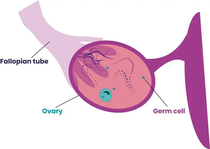 Germ Cell Tumor itu Apa? Kenali, Tangani dan Cara Pengobatannya