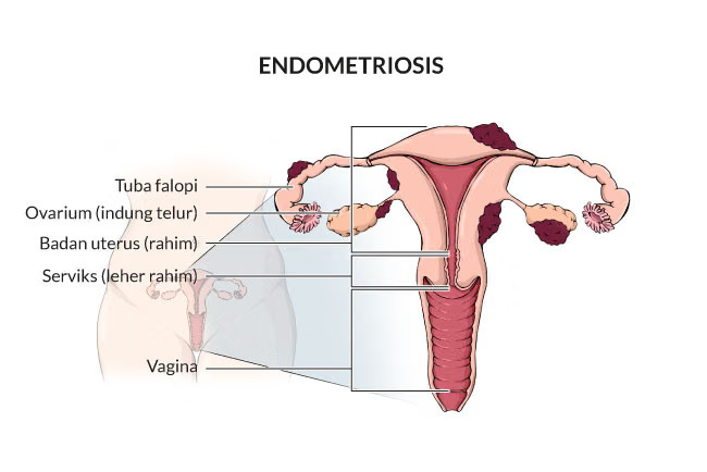 Sering Nyeri Haid Berlebihan? Kenali Gejala Endometriosis Sejak Dini