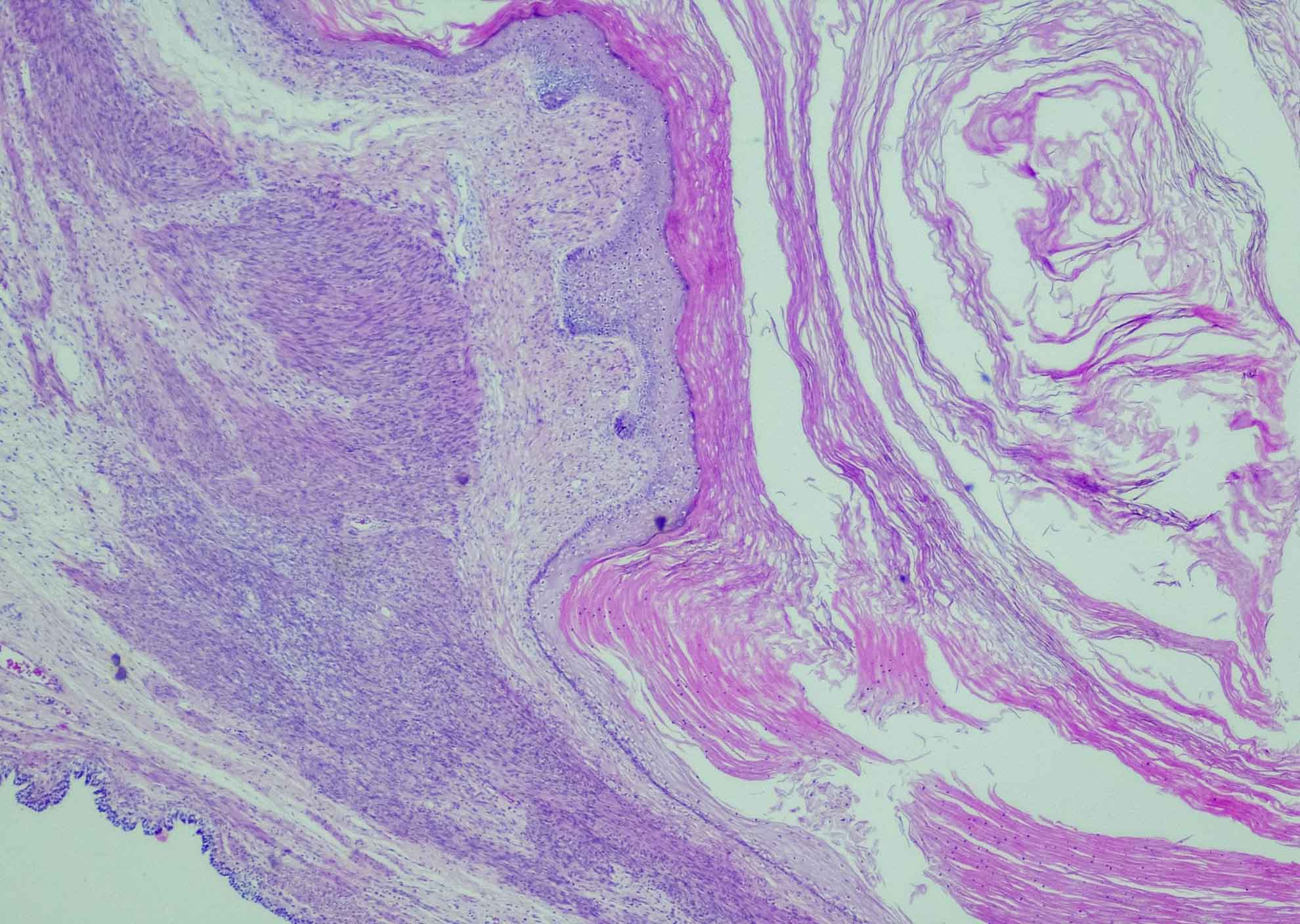 Mengenal Immature Teratoma: Ciri, Penyebab, dan Contoh Kasusnya